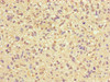 Immunohistochemistry of paraffin-embedded human glioma using CSB-PA754628LA01HU at dilution of 1:100