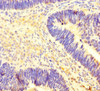 Immunohistochemistry of paraffin-embedded human ovarian cancer using CSB-PA771462LA01HU at dilution of 1:100
