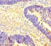 Immunohistochemistry of paraffin-embedded human ovarian cancer using CSB-PA771462LA01HU at dilution of 1:100
