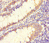 Immunohistochemistry of paraffin-embedded human colon cancer using CSB-PA774794LA01HU at dilution of 1:100