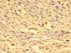 Immunohistochemistry of paraffin-embedded human melanoma using CSB-PA809015LA01HU at dilution of 1:100