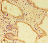 Immunohistochemistry of paraffin-embedded human prostate cancer using CSB-PA821675HA01HU at dilution of 1:100