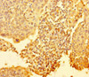 Immunohistochemistry of paraffin-embedded human cervical cancer using CSB-PA821675HA01HU at dilution of 1:100
