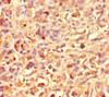 Immunohistochemistry of paraffin-embedded human melanoma using CSB-PA835706LA01HU at dilution of 1:100