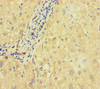 Immunohistochemistry of paraffin-embedded human liver cancer using CSB-PA836713LA01HU at dilution of 1:100