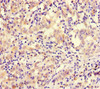 Immunohistochemistry of paraffin-embedded human lung cancer using CSB-PA839275LA01HU at dilution of 1:100
