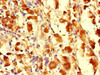 Immunohistochemistry of paraffin-embedded human melanoma using CSB-PA842170LA01HU at dilution of 1:100
