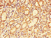 Immunohistochemistry of paraffin-embedded human gastric cancer using CSB-PA847687LA01HU at dilution of 1:100