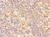 Immunohistochemistry of paraffin-embedded human cervical cancer using CSB-PA847687LA01HU at dilution of 1:100