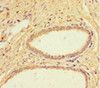 Immunohistochemistry of paraffin-embedded human prostate cancer using CSB-PA850426LA01HU at dilution of 1:100
