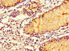 Immunohistochemistry of paraffin-embedded human colon cancer using CSB-PA875673LA01HU at dilution of 1:100