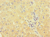 Immunohistochemistry of paraffin-embedded human liver cancer using CSB-PA882187HA01HU at dilution of 1:100