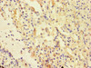 Immunohistochemistry of paraffin-embedded human lung cancer using CSB-PA882187HA01HU at dilution of 1:100