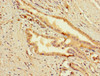 Immunohistochemistry of paraffin-embedded human prostate cancer using CSB-PA883371LA01HU at dilution of 1:100