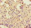 Immunohistochemistry of paraffin-embedded human breast cancer using CSB-PA884479LA01HU at dilution of 1:100