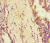 Immunohistochemistry of paraffin-embedded human lung cancer using CSB-PA884479LA01HU at dilution of 1:100