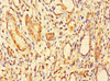 Immunohistochemistry of paraffin-embedded human gastric cancer using CSB-PA890914LA01HU at dilution of 1:100