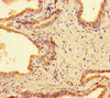 Immunohistochemistry of paraffin-embedded human prostate cancer using CSB-PA892345LA01HU at dilution of 1:100 Immunohistochemistry of paraffin-embedded human prostate cancer using CSB-PA892345LA01HU at dilution of 1:100