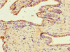 Immunohistochemistry of paraffin-embedded human prostate cancer using CSB-PA897529LA01HU at dilution of 1:100