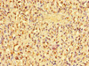 Immunohistochemistry of paraffin-embedded human gastric cancer using CSB-PA001825LA01HU at dilution of 1:100
