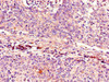 Immunohistochemistry of paraffin-embedded human cervical cancer using CSB-PA005089LA01HU at dilution of 1:100