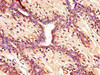 Immunohistochemistry of paraffin-embedded human breast cancer using CSB-PA005089LA01HU at dilution of 1:100