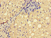 Immunohistochemistry of paraffin-embedded human liver cancer using CSB-PA007720LA01HU at dilution of 1:100