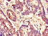 Immunohistochemistry of paraffin-embedded human colon cancer using CSB-PA010166LA01HU at dilution of 1:100