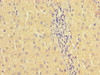 Immunohistochemistry of paraffin-embedded human liver cancer using CSB-PA010652LA01HU at dilution of 1:100