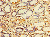 Immunohistochemistry of paraffin-embedded human gastric cancer using CSB-PA010988LA01HU at dilution of 1:100
