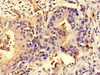 Immunohistochemistry of paraffin-embedded human bladder cancer using CSB-PA015871LA01HU at dilution of 1:100