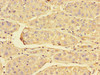 Immunohistochemistry of paraffin-embedded human liver cancer using CSB-PA018656LA01HU at dilution of 1:100