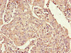 Immunohistochemistry of paraffin-embedded human cervical cancer using CSB-PA020614LA01HU at dilution of 1:100