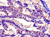 Immunohistochemistry of paraffin-embedded human colon cancer using CSB-PA022575LA01HU at dilution of 1:100
