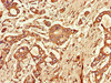 Immunohistochemistry of paraffin-embedded human pancreatic cancer using CSB-PA023602LA01HU at dilution of 1:100