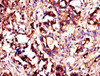 Immunohistochemistry of paraffin-embedded human gastric cancer using CSB-PA026253LA01HU at dilution of 1:100