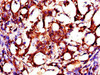 Immunohistochemistry of paraffin-embedded human gastric cancer using CSB-PA026504LA01HU at dilution of 1:100