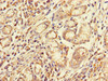 Immunohistochemistry of paraffin-embedded human gastric cancer using CSB-PA04459A0Rb at dilution of 1:100