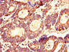 Immunohistochemistry of paraffin-embedded human colon cancer using CSB-PA04629A0Rb at dilution of 1:100