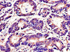 Immunohistochemistry of paraffin-embedded human colon cancer using CSB-PA09499A0Rb at dilution of 1:100