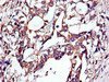 Immunohistochemistry of paraffin-embedded human gastric cancer using CSB-PA09499A0Rb at dilution of 1:100