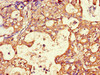 Immunohistochemistry of paraffin-embedded human gastric cancer using CSB-PA13909A0Rb at dilution of 1:100