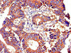 Immunohistochemistry of paraffin-embedded human colon cancer using CSB-PA18129A0Rb at dilution of 1:100