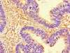 Immunohistochemistry of paraffin-embedded human ovarian cancer using CSB-PA618759LA01HU at dilution of 1:100