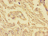 Immunohistochemistry of paraffin-embedded human pancreatic cancer using CSB-PA623815LA01HU at dilution of 1:100