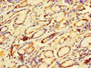 Immunohistochemistry of paraffin-embedded human gastric cancer using CSB-PA623906LA01HU at dilution of 1:100