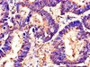 Immunohistochemistry of paraffin-embedded human colon cancer using CSB-PA636328LA01HU at dilution of 1:100