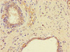 Immunohistochemistry of paraffin-embedded human prostate cancer using CSB-PA643662LA01HU at dilution of 1:100