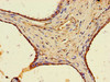 Immunohistochemistry of paraffin-embedded human prostate cancer using CSB-PA818226LA01HU at dilution of 1:100