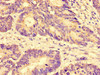 Immunohistochemistry of paraffin-embedded human colon cancer using CSB-PA884504LA01HU at dilution of 1:100